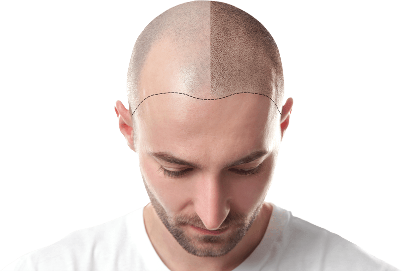 candidate for scalp micropigmentation