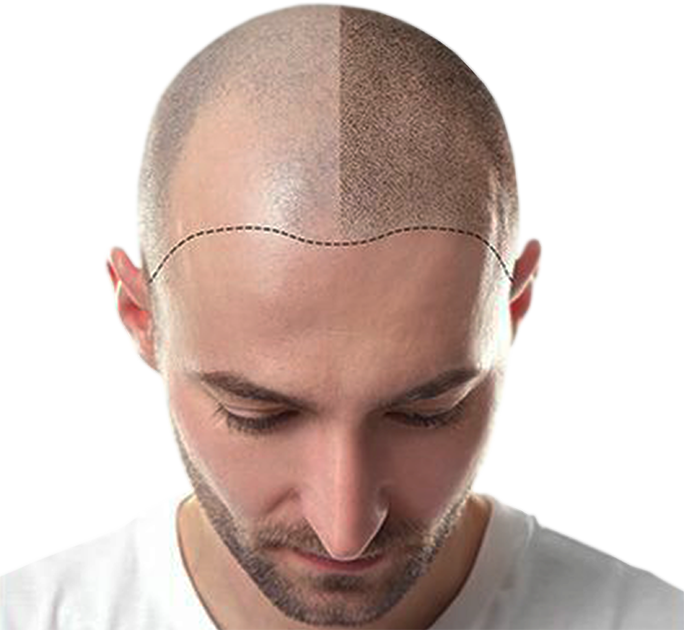 scalp micropigmentation cost