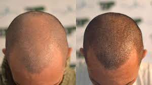 3D Scalp Micropigmentation