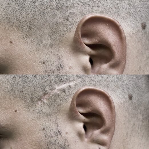 scar revision procedure