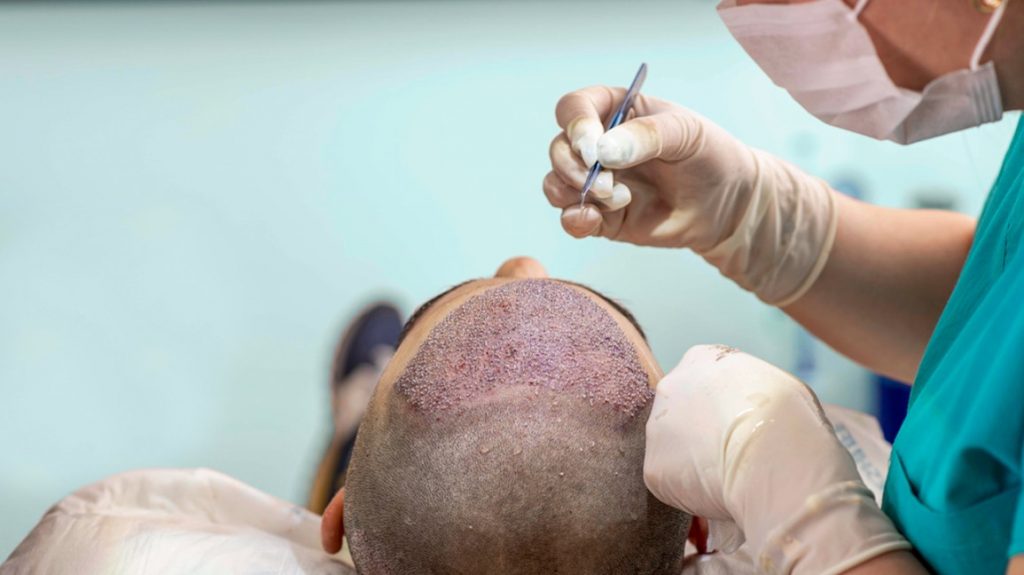 hair restoration procedure