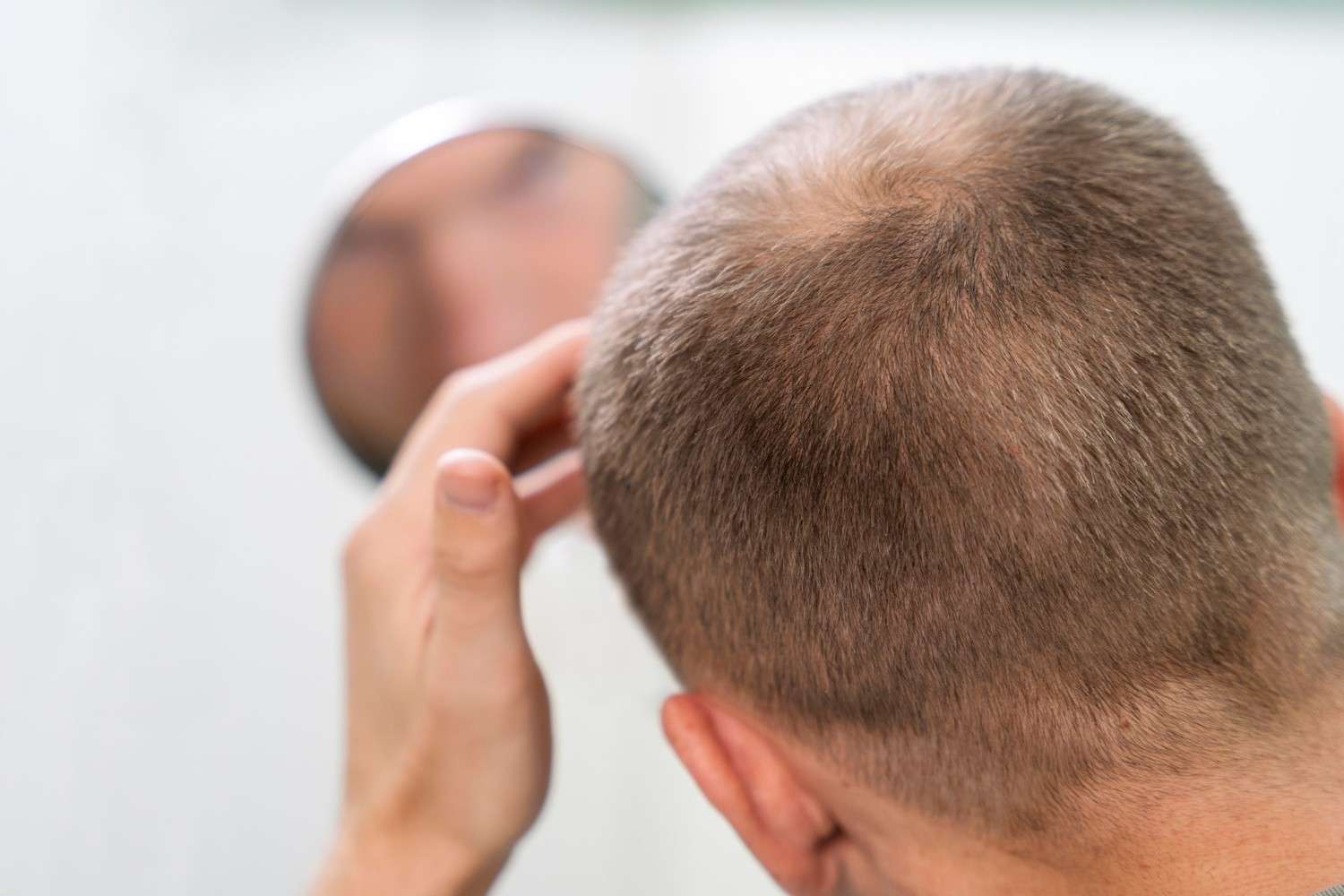 scalp micropigmentation for alopecia
