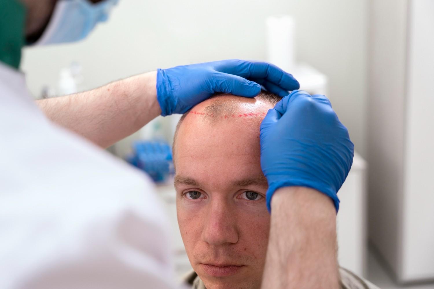 scalp micropigmentation aftercare