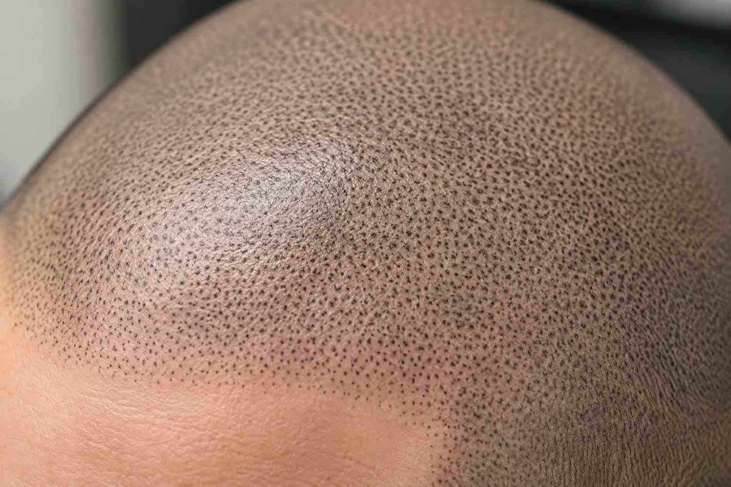 scalp micropigmentation scar texture